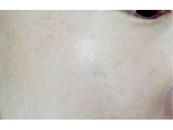 リベル 名古屋(Lebelle:)/名古屋 ハーブピーリング