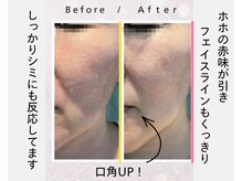 アイリー(iley)/ビフォーアフター