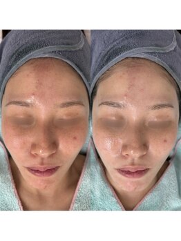 イーヴ(Eave)/【肌質改善】ハイドラ毛穴洗浄