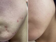 レイ(Rei)/剥離ありのハーブピーリングです