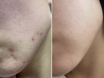 レイ(Rei)/剥離ありのハーブピーリングです