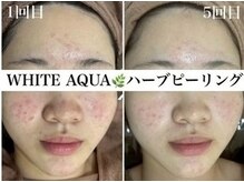 ホワイトアクア 四日市店(WHITE AQUA)/毛穴改善ハーブピーリング