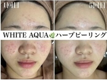ホワイトアクア 四日市店(WHITE AQUA)/毛穴改善ハーブピーリング