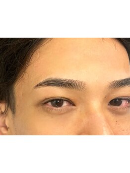 顔脱毛がしたい