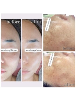 ラヴィソンファム(Ravissant femme)の写真/変化に驚き!ホワイトスノーピーリングで肌負担なく水光肌へ!透き通る白を目指して肌全体のくすみ&シミケア