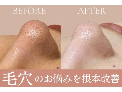 エピル(EPIL)の写真