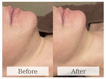 ルミラポー(Lumira Peau)/小顔 リフトアップ