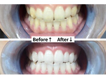 シエスタビューティラボ/プレミアムホワイトニング5回