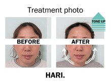 ハリドット 天王寺院(HARI.)/美顔鍼＋フェイシャル40代