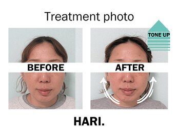 ハリドット 天王寺院(HARI.)/美顔鍼+フェイシャル40代