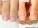 自爪育成・深爪・川崎