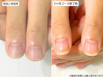 カピリナ(Ka Pilina)/自爪育成・深爪・川崎