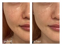 ミースプラス(me,as+)/高周波サーマ 全顔1回 (術後2w)