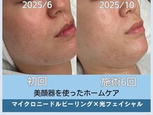 アロマ(AROMA)/凹凸跡/毛穴/越谷せんげん台