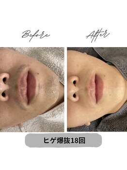 プレジール 大野城店(plaisir)/ヒゲ脱毛