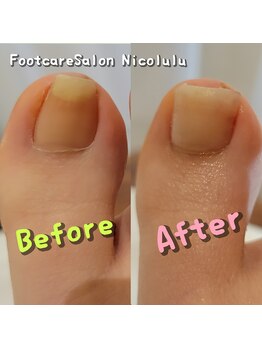 ニコルル 大阪天満店(Nicolulu)/見た目が気になる巻き爪