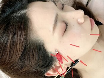 ユイユイマール(Yui Yui Maru)/美容鍼×EMSでリフトアップ!