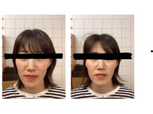 田端整体院/あごがすっきり小顔整体