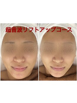 ちゅるん肌ドットコム 石橋店(ちゅるん肌.com)/超音波リフト1回の変化