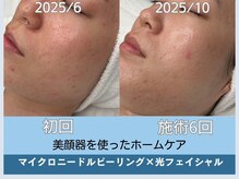 アロマ(AROMA)/凹凸跡/毛穴/越谷せんげん台