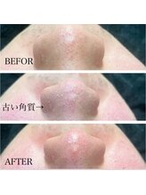 メンズプシュケ(men's PSYCHE)/毛穴洗浄