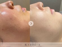 スパレーカ(Spa laka)の雰囲気（【 ララピール & 光カスタマイズ 】くすみ・美白・ニキビケア ☆）