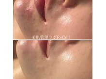 リセル 月島(ReCeLL)の雰囲気（【先進施術】大人ニキビ・痕をケアして驚きの滑らかツヤ肌）