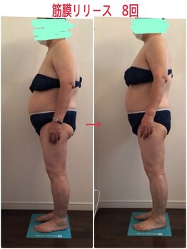 ビューティー サロン ハナ(Beauty Salon hana)/筋膜×痩身マシーン8回施術効果