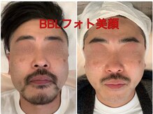 ちゅるん肌ドットコム 石橋店(ちゅるん肌.com)/BBLフォト美顔月1！1年間の変化