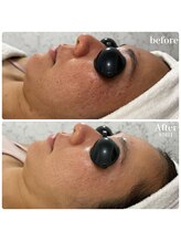 リアム(LiAm)/うる艶肌 第4世代ララピール