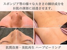 美肌研究所 東京新宿支店の雰囲気（棘状成分を入れ込むのにも施術者の技術が必須です！）