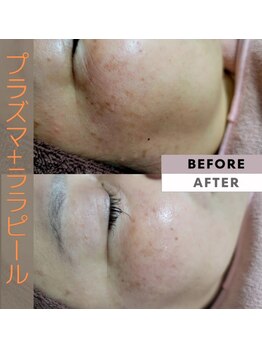 エスボーテ(sbeaute)/プラズマ+ララピール