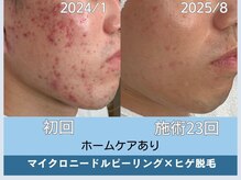 アロマ(AROMA)/　ニキビ・凹凸跡・毛穴改善