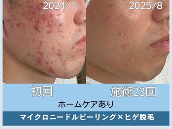 アロマ(AROMA)/　ニキビ・凹凸跡・毛穴改善