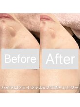 リンダ 西宮店(LINDA)/毛穴改善＋エイジングケア♪