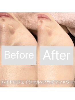 リンダ 西宮店(LINDA)/毛穴改善＋エイジングケア♪