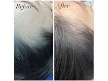 ジュエカフネ 広尾(JueCAFUNe)の雰囲気(プラズマと幹細胞培養上清液を使用し、これまでにない育毛促進を)