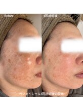 シロ(silo)/光フェイシャル4回の変化