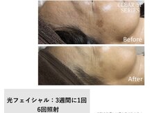 グランデ(Grande)/光フェイシャルでシミケア◎