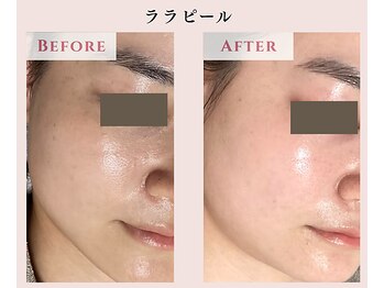 レクラ バイ ドクターエイチ(L'ECLAT by Doctor.H)/ララピール