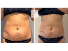 マシェリ 吉祥寺(Macherie)/脂肪燃焼　10ml導入