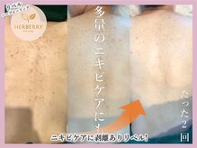 ハーバリー ハーブピーリング 大阪梅田店(HERBERRYハーブピーリング)/梅田ハーブピーリングHERBERRY