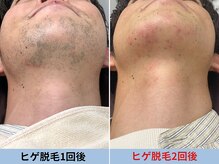 ミスターアンクール 鹿児島(Mr.uncoeur)/ヒゲ脱毛1回後と2回後