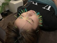 たんぽぽ整骨院鍼灸院/美容鍼♪