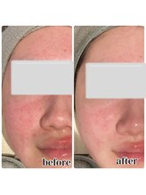 レピア つくば店(LEPIA)/敏感肌の方もOK