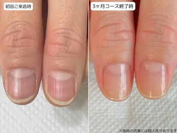 カピリナ(Ka Pilina)/自爪育成・深爪・川崎