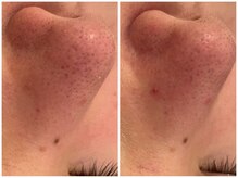 メゾンリュバン 梅田店(Maison Ruban)/毛穴洗浄・美白フォト|毛穴ケア