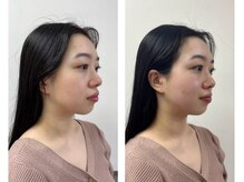 ヘッドミント 南越谷店/小顔矯正コルギ◎小顔効果