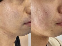 シロ(Shiro)/ひげ脱毛（パック付き）