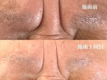 ルアーナ(Luana)/眉間のしわ ハーブピーリング